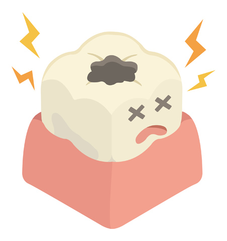 歯の神経を残す治療